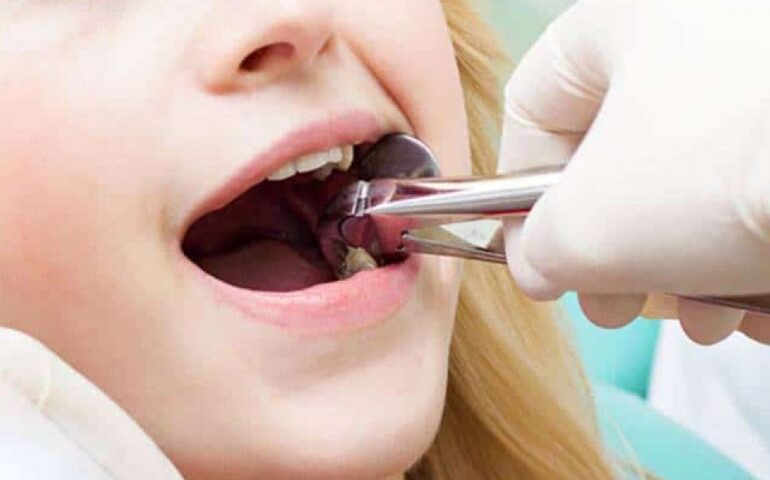 تفسير-حلم-خلع-الضرس-المسوس