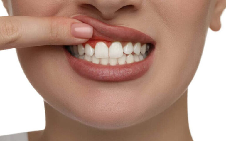 agresif-periodontitis-tedavisi-1170x658