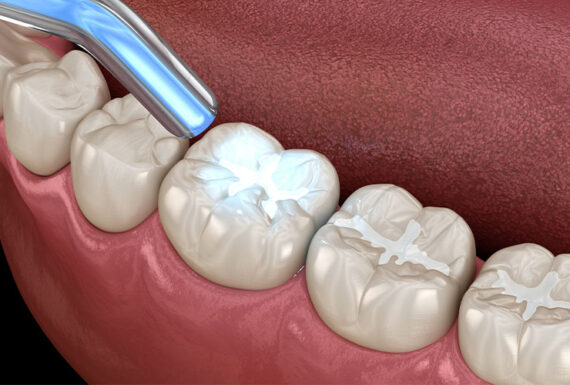 Diş Dolgusu