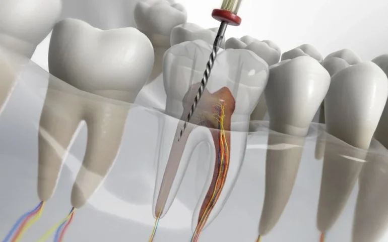 kanal-tedavisi-fiyatlari